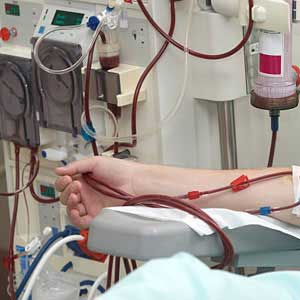 hemodialysis