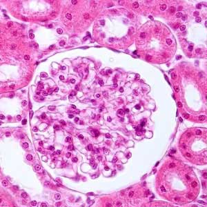 nephrotic syndrome in Vijayawada