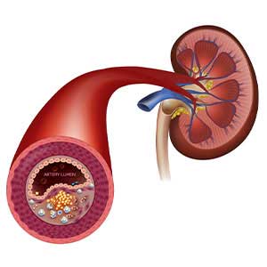 Renal Hypertension in vijayawada